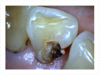 前歯のウラ側