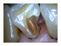 虫歯の部分